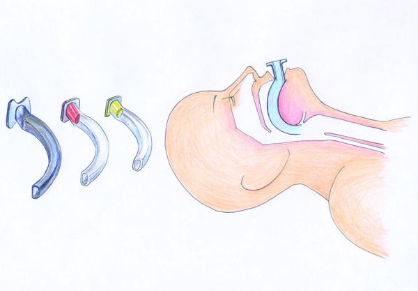 TUBO GUEDEL ADOLESCENTE